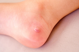 How to Prevent Sock Blisters