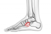 About Cuboid Syndrome