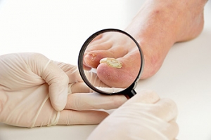 Toenail Fungus is an Infection