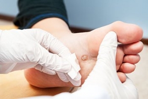 I Have a Foot Wart - Should I Be Worried?