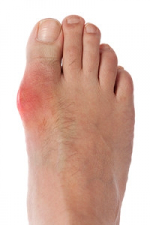 What You Can Do to Help Mitigate Gout