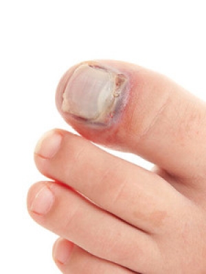 How Do Broken Toes Heal?
