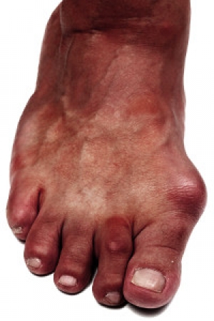 Is a Bunion a Permanent Deformity?