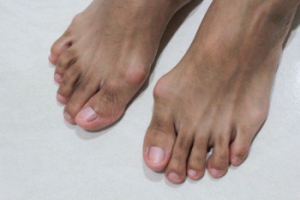 Facts About Bunion Surgery