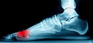 What Part of the Foot Does Morton’s Neuroma Affect?