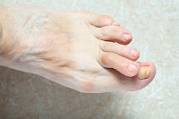 Treatment for Overlapping Toes